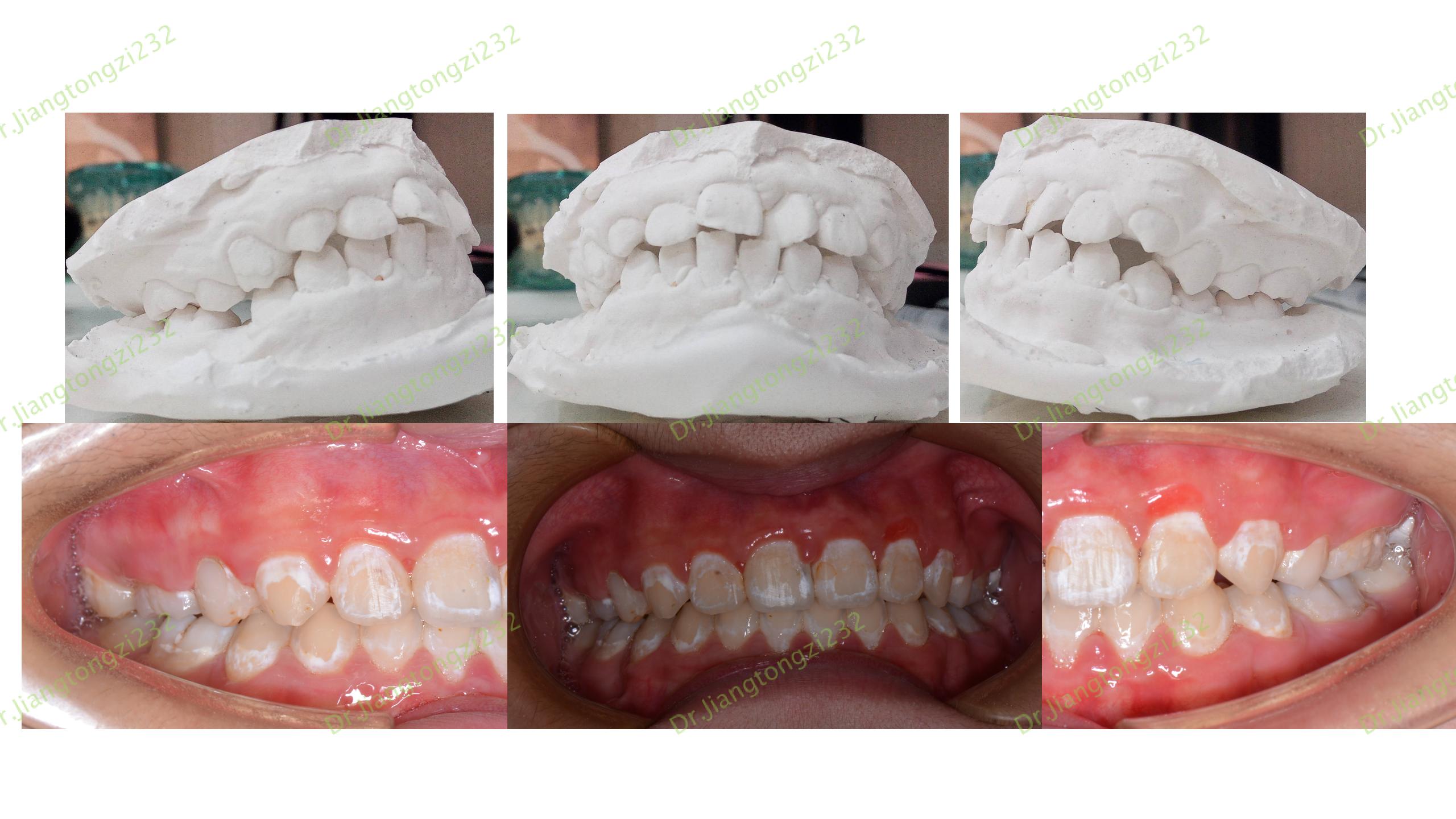 《正畸案例47:牙齿矫正后的牙面白斑》