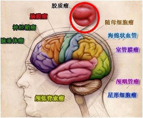 脑胶质瘤怎样做到尽可能全切