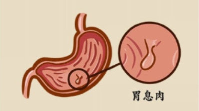 胃里长了息肉严重嘛?可能说明胃变好了!