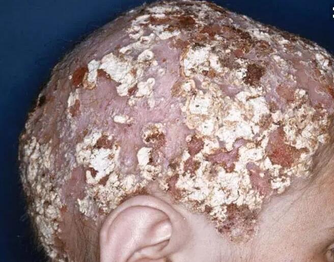 细说11种常见的真菌性皮肤病