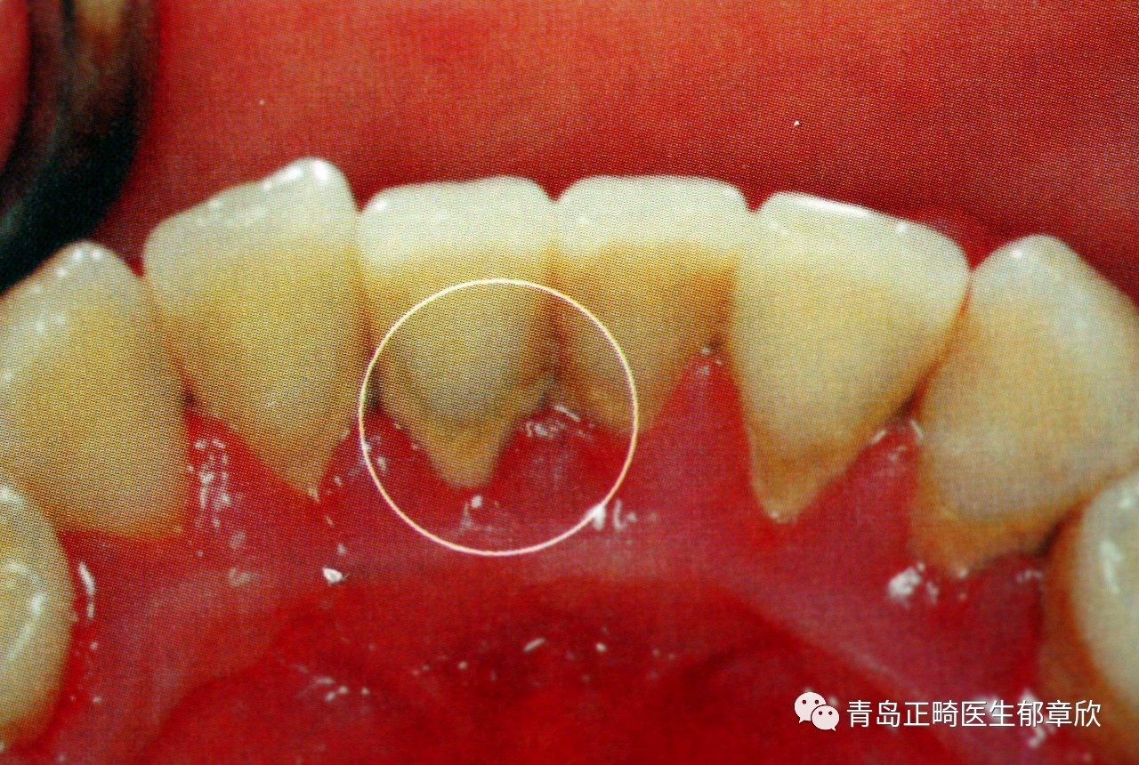 今天牙菌斑图片牙菌斑长什么样子图片牙菌斑和牙结石图片牙菌斑牙垢