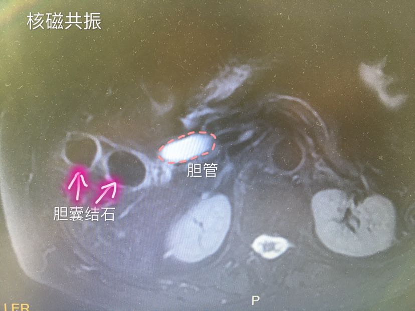 胆结石,ct和mri区别大