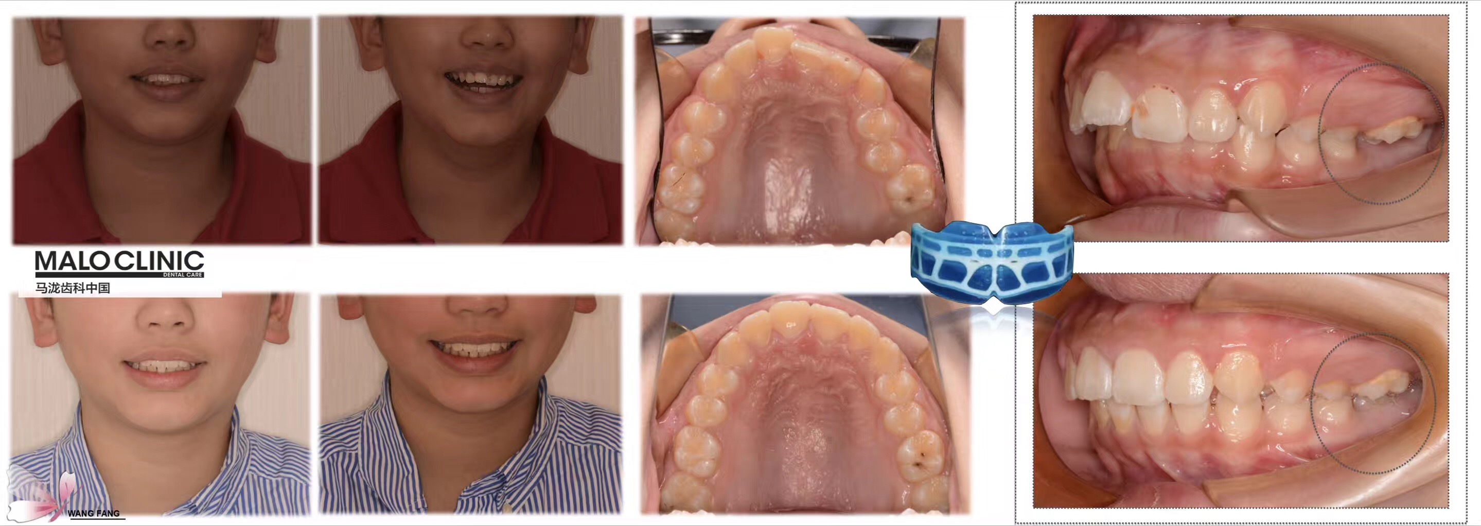 mrc-如何正确佩戴?