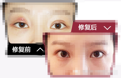 安全分离开严重的粘连,三部分层缝合法固定适当高度的双眼皮
