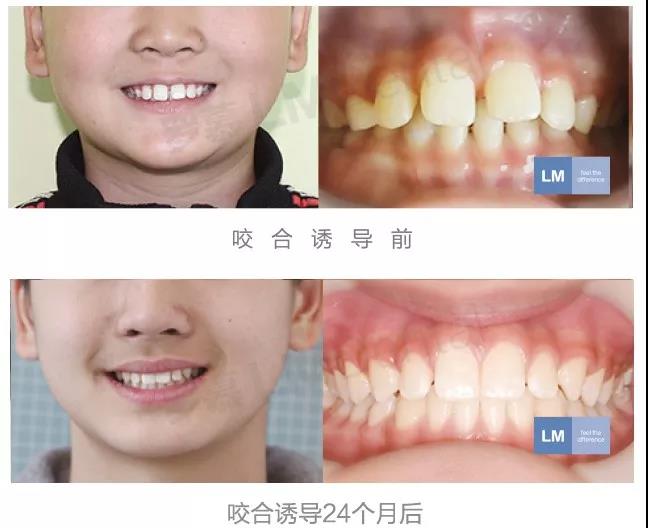 那些做了咬合诱导矫正的宝宝后来都怎么样了效果如何