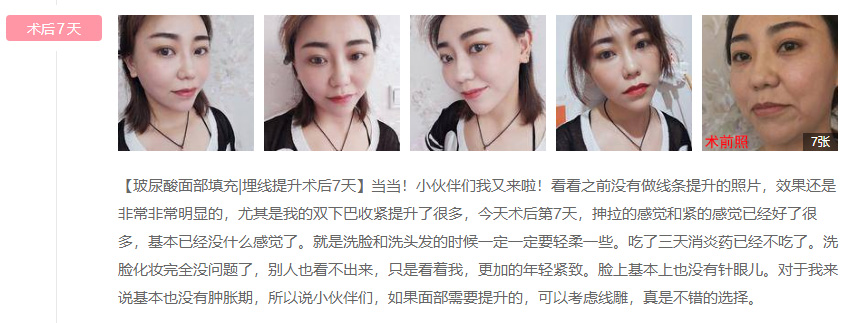 【 综合诊断建议方案】 (1)苹果肌两侧点少量溶脂; (2)法令纹,颈阔肌