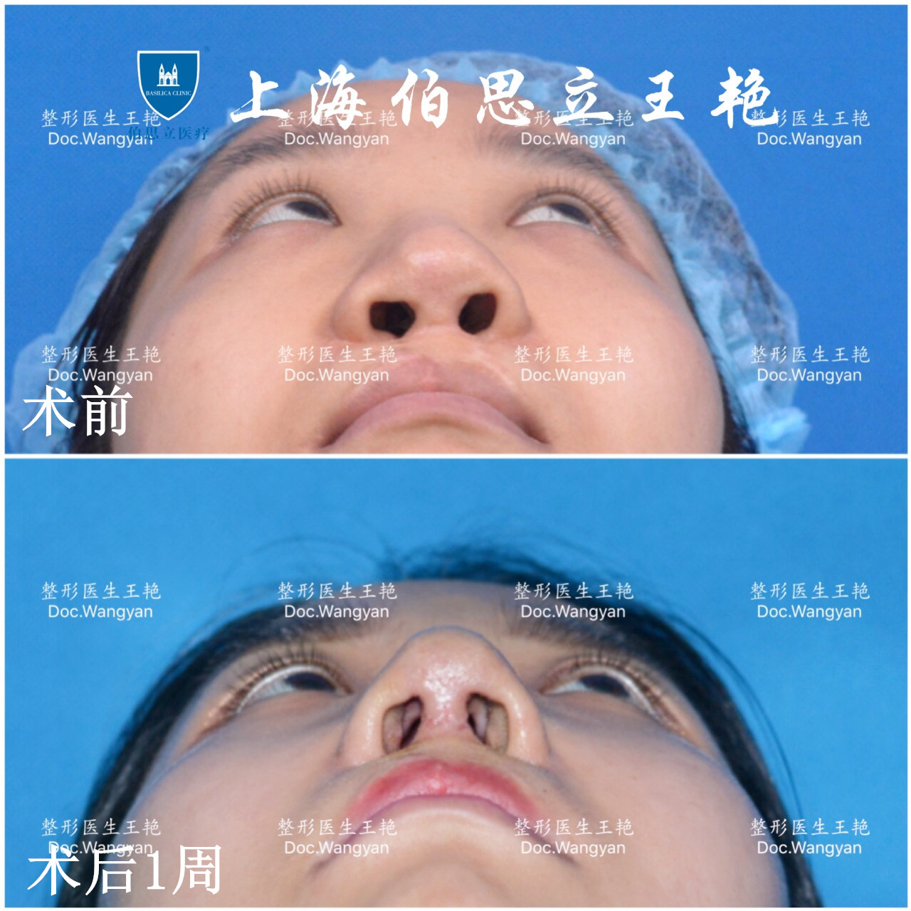 19岁在北京某医院做了第一次隆鼻手术,方案是l型硅胶假体 耳软骨.