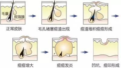 激光祛痘的原理