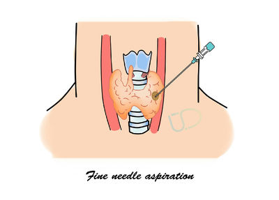 甲状腺结节常见问与答
