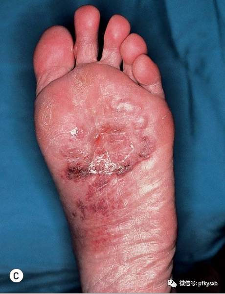 夏季常见皮肤病之一:脚气君的自白