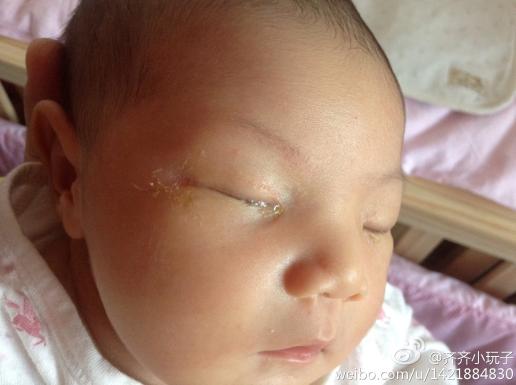 出生11天女宝宝,最近眼睛周围的眼屎特别多,眼睛外是