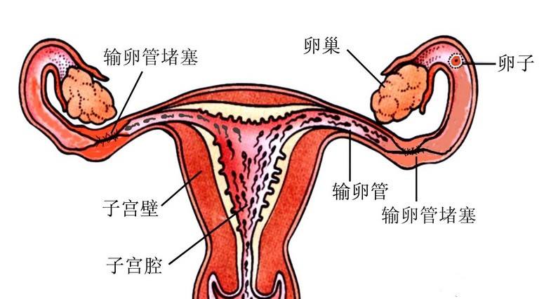 输卵管积水会导致不孕吗有哪些症状表现呢