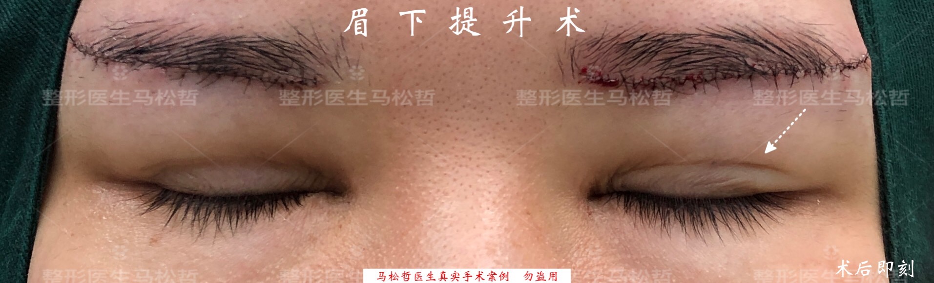 (图5 而且此时双眼皮切口线松弛的皮肤已经得到提拉改善