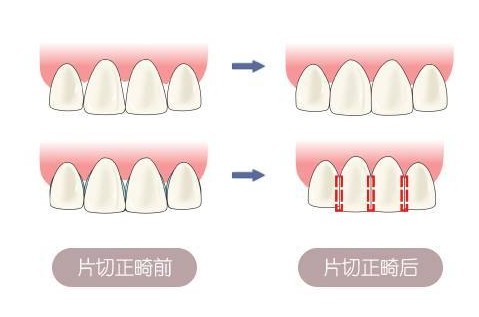 牙齿矫正中的"邻面去釉"是什么?