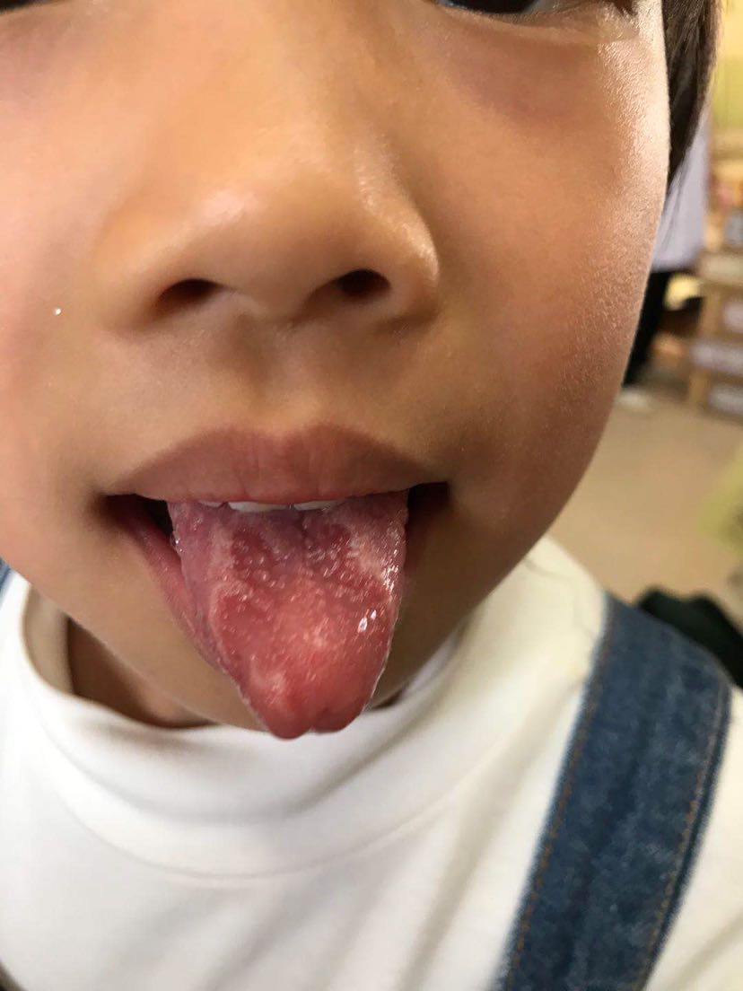 幼儿园体检发现小孩子舌苔萎缩