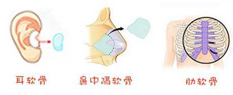 耳软骨隆鼻和肋软骨隆鼻有什么区别?