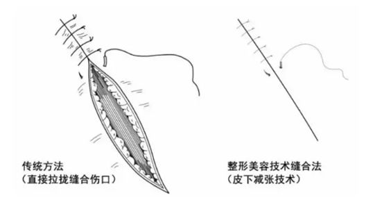 精细美容缝合—让外伤后疤痕最小化