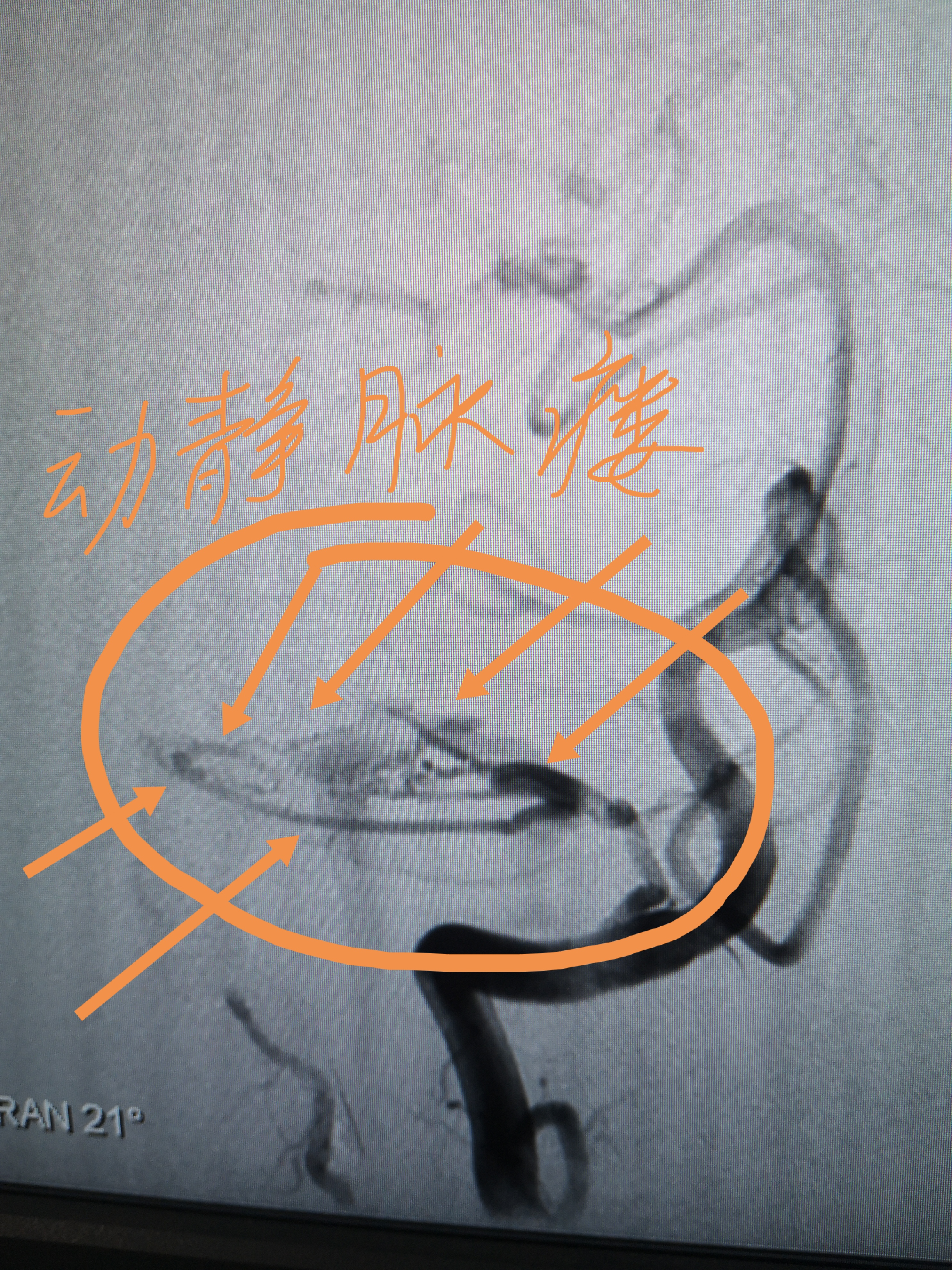 dr盖延廷61硬脑膜动静脉瘘顺利栓塞