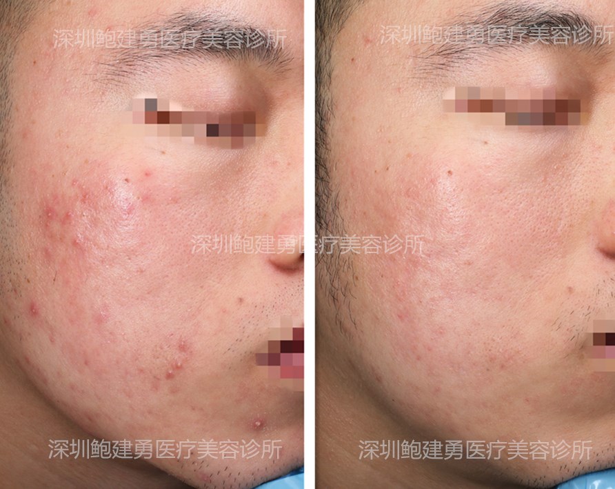 科普|面部细菌性毛囊炎的诊断和治疗