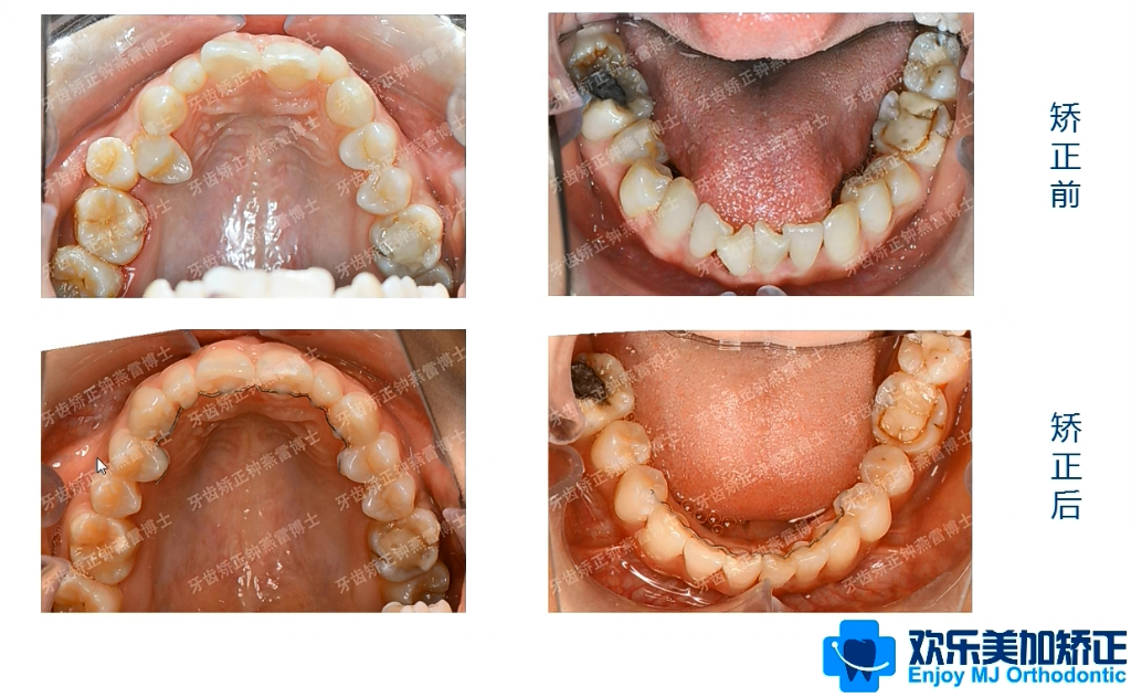 治疗后牙齿排列整齐,倾斜的牙齿都变得直立