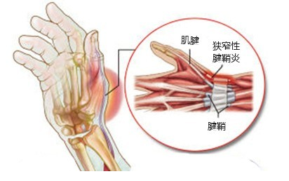 得了腱鞘炎,有哪些表现,该如何治疗?专家为你支招!