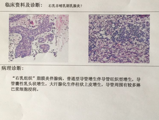 右乳浆细胞性乳腺炎右乳头内陷