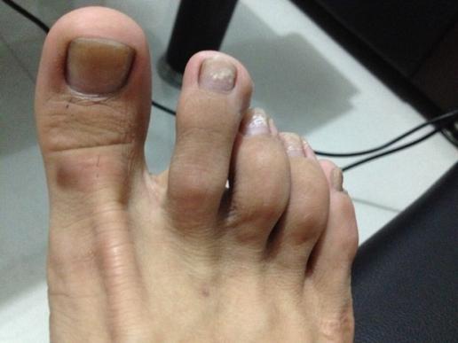 我的脚趾甲几十年来都是这副样子，问是灰趾甲吗?