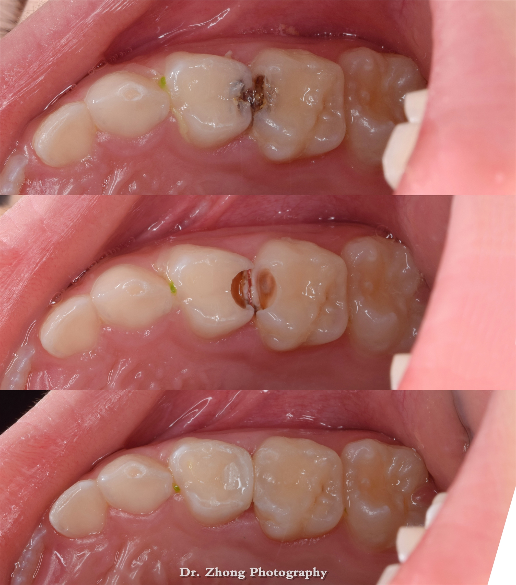 二,乳牙龋齿补牙后注意事项