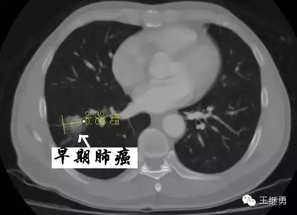 "全球肺癌关注月"义诊