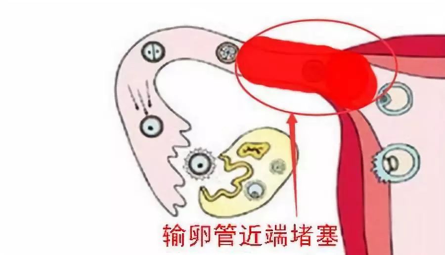 x线输卵管造影检查是可以很精准的看到输卵管内部的正式形态,输卵