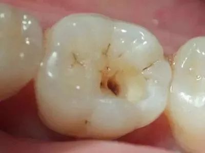 图为中度龋齿 深层龋齿:细菌到达牙本质深层,接近牙髓,咬东西时会感到