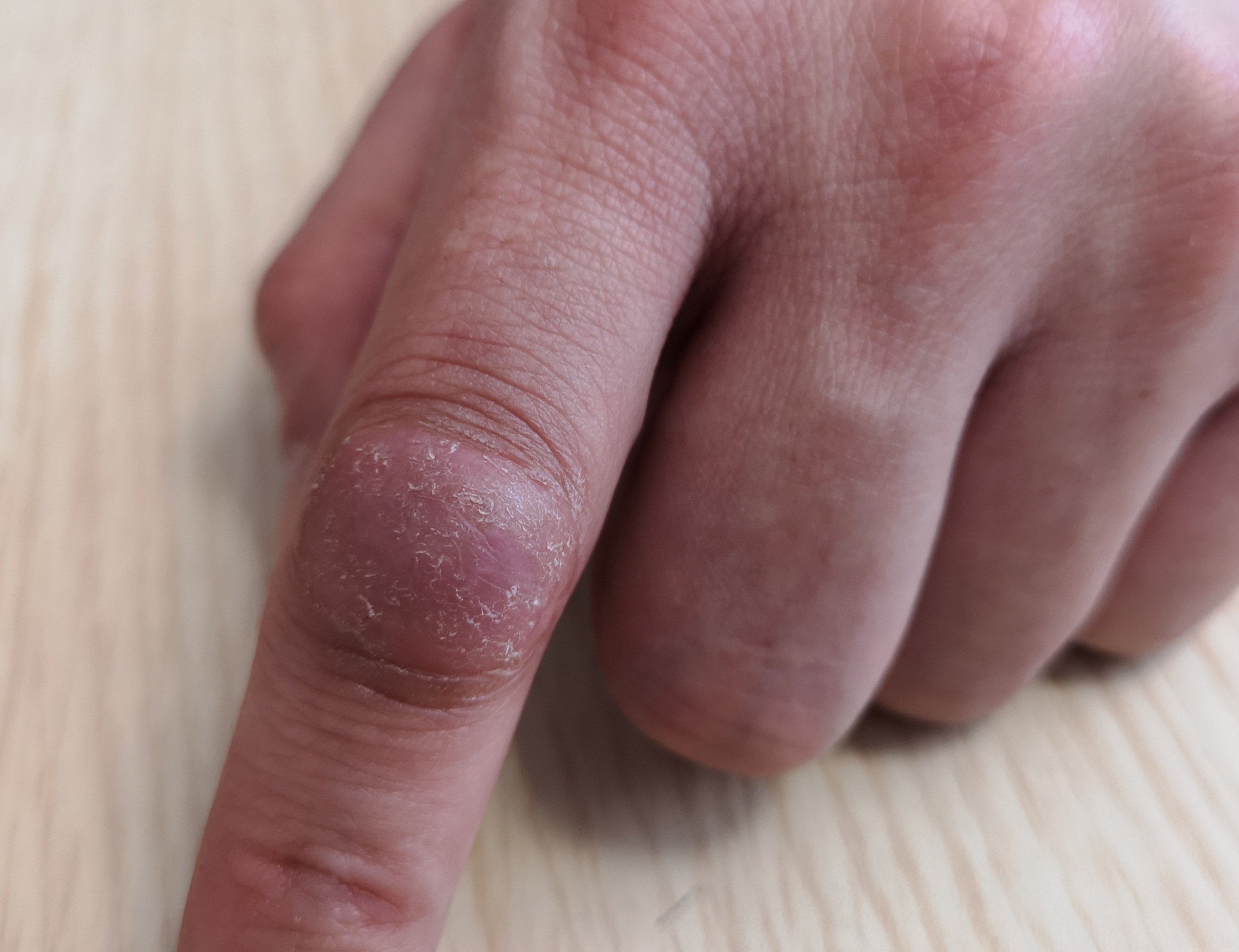 人的手指有三节指骨,所以每根手指有两个指间关节,分别称为近段指间