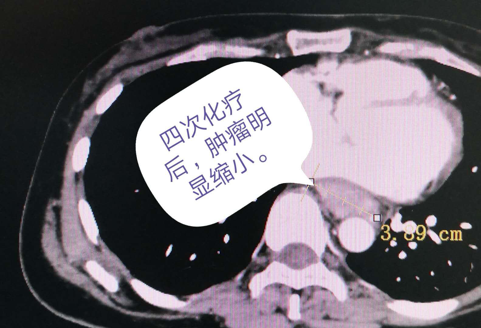 食管癌化疗后.jpg