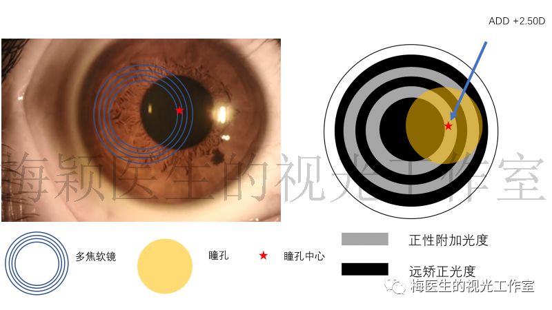 探秘儿童近视控制的新工具多焦接触镜之软性多焦接触镜