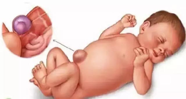 宝宝肚脐眼居然鼓出一个包到底什么时候会好要手术吗