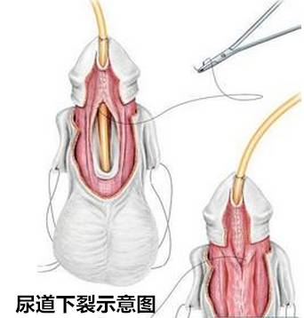 尿道下裂,小儿生殖器先天畸形,手术要趁早