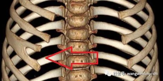 叉状肋与胸廓畸形