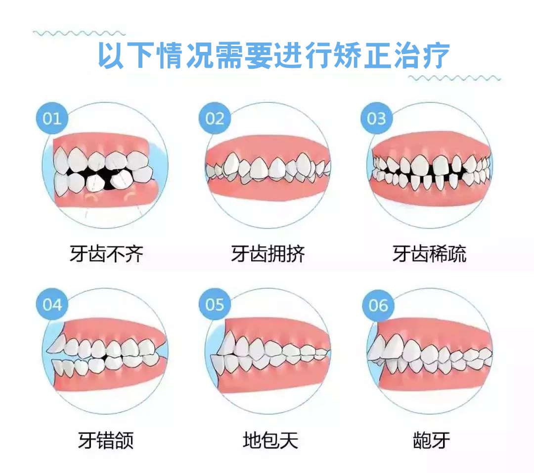 牙齿矫正的原理