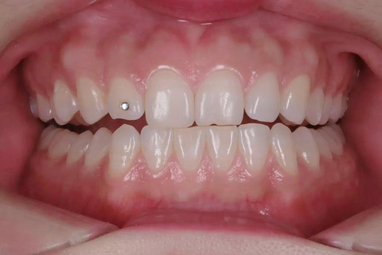 牙齿对刃咬合有什么危害?
