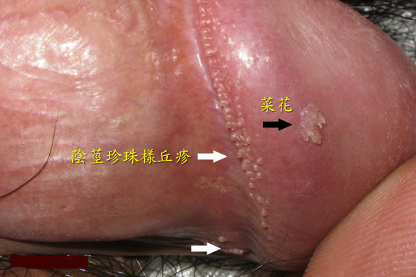 下方图片所示珍珠样丘疹和尖锐湿疣共存