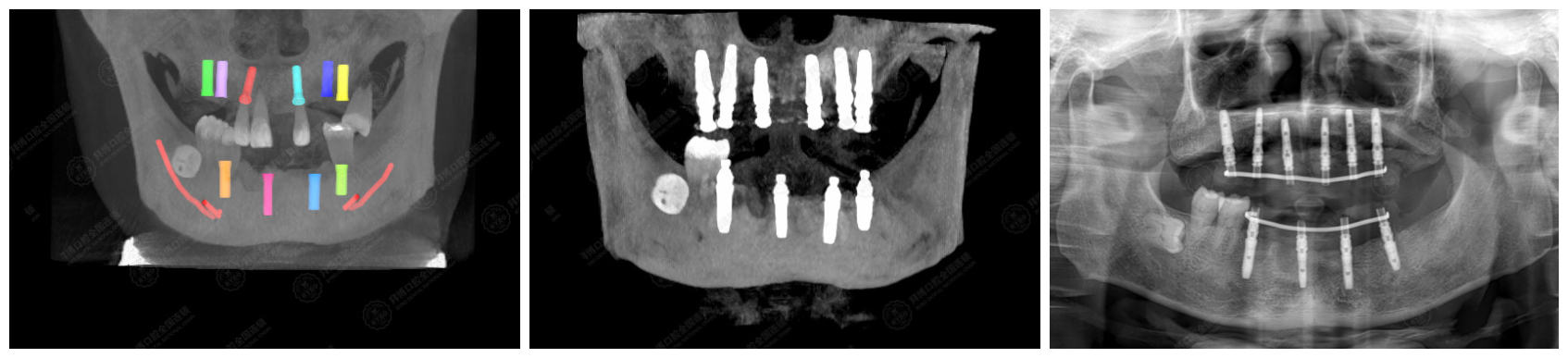 术前cbct 设计,术后ct 及戴牙后全景片