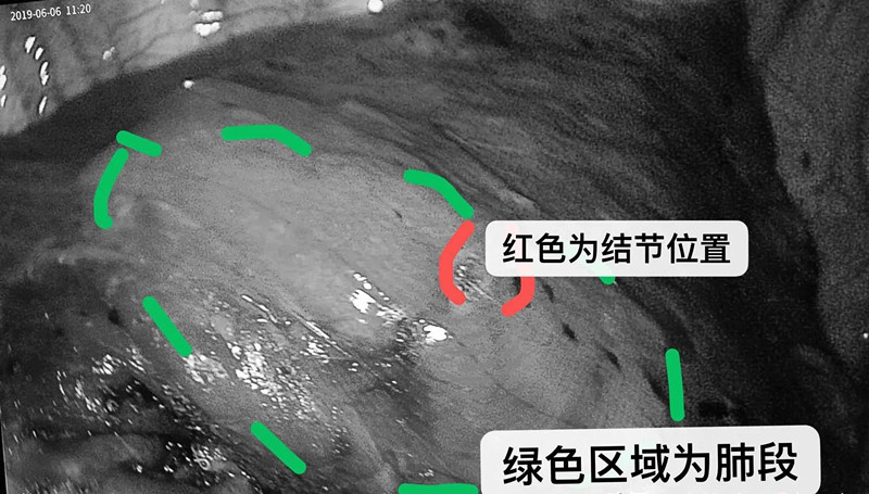 35岁妈妈查出微浸润腺癌,做完手术就没事了