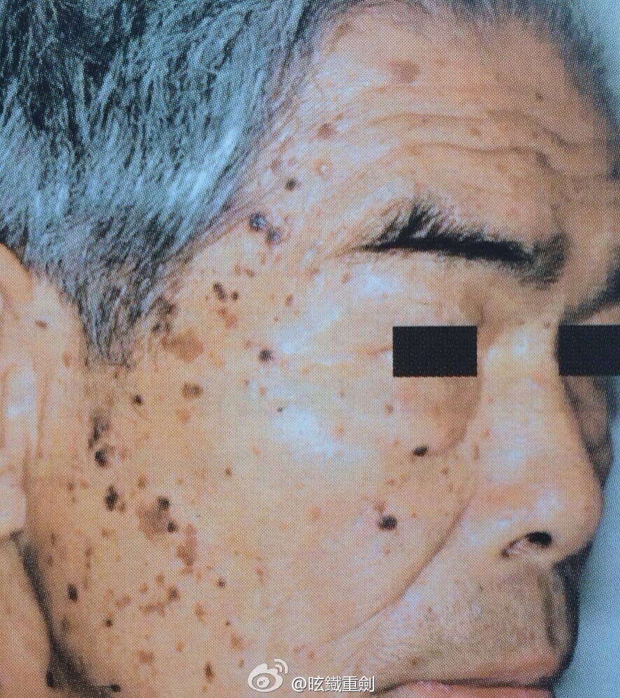 ②脂溢性角化病(seborrheickeratosis/sk),又称为老年斑,日光性斑痣.