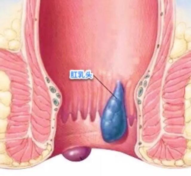 怎么判断自己是否有了痔疮?