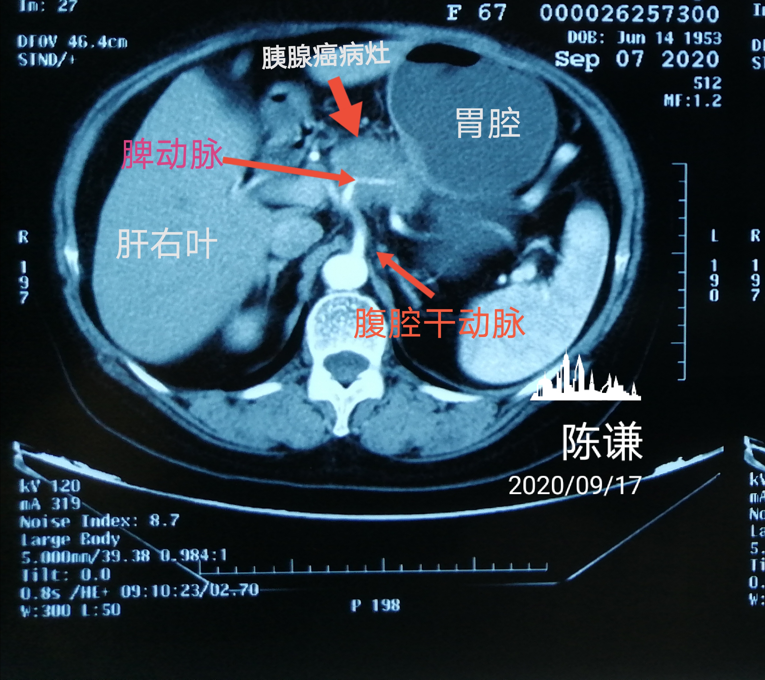 从病人的ct和pet/ct检查来看,病人属于晚期胰腺癌,肿瘤已经侵犯腹腔干