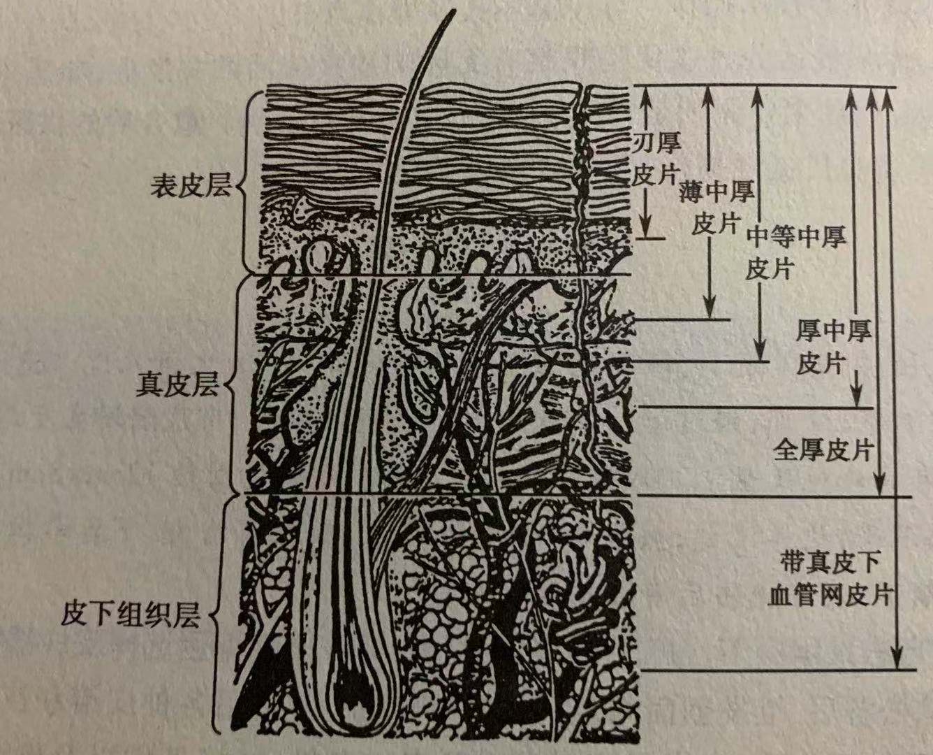 薄中厚,中等中厚,厚中厚),全厚皮片及含真皮下血管网皮片