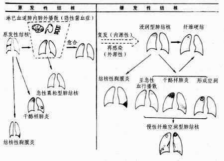 血型播散型肺结核:分为(急性血型播散型