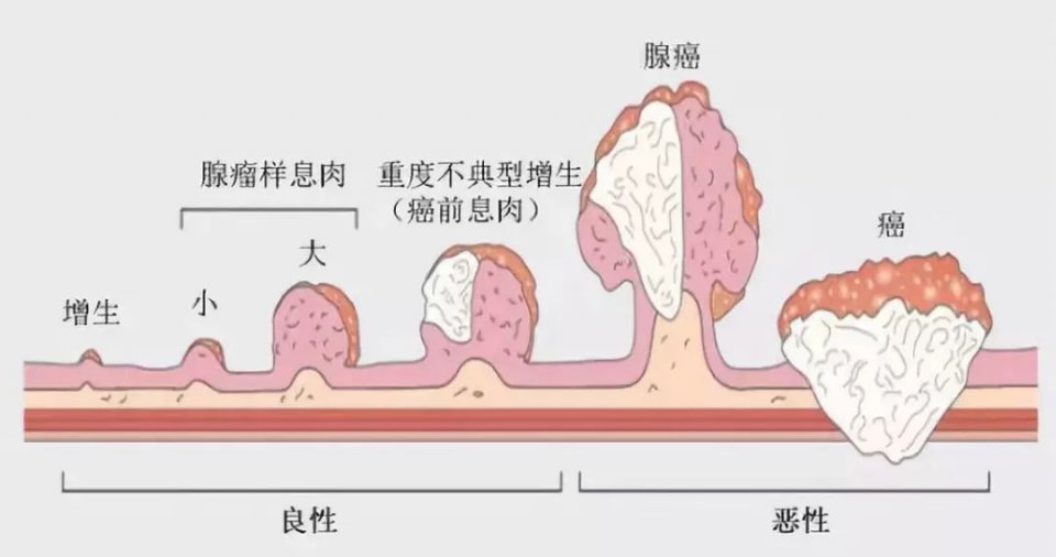 胃癌发病率第二,死亡率第三,防治胃癌,癌前病变是关键