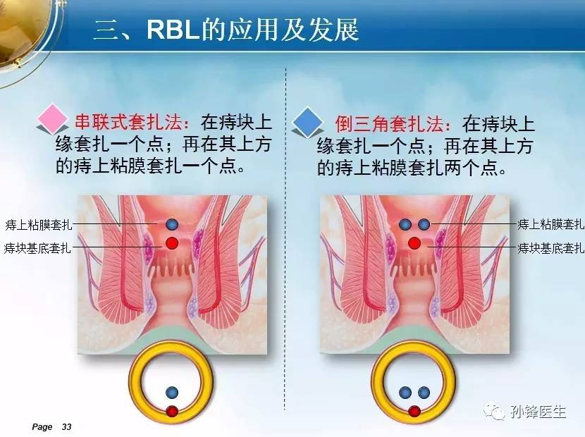 原创|痔套扎手术的决策与pph的再思考