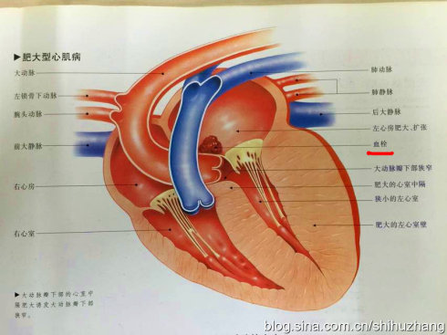 肥厚性心肌病的特征为心室肌肥厚,典型者在左心室,以室间隔为甚,偶而